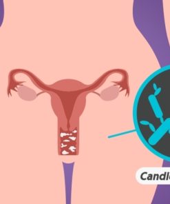Candidíase vaginal